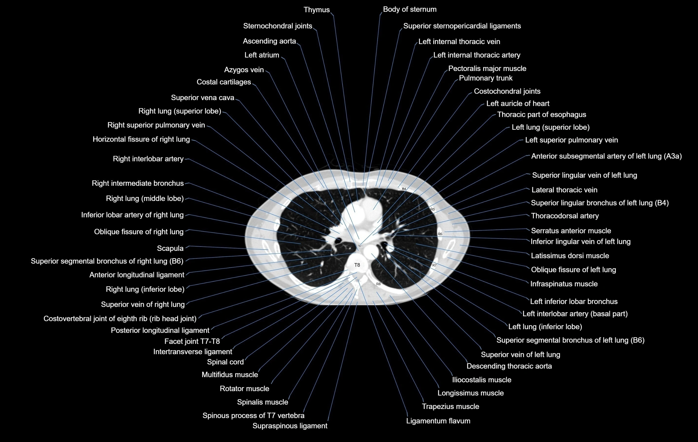 CT chest (thorax) labelled axial cross sectional anatomy radiology image-00061.webp